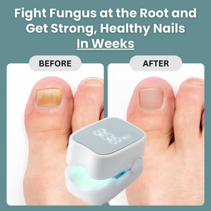 Buyera™ - Nail Fungus Laser Device
