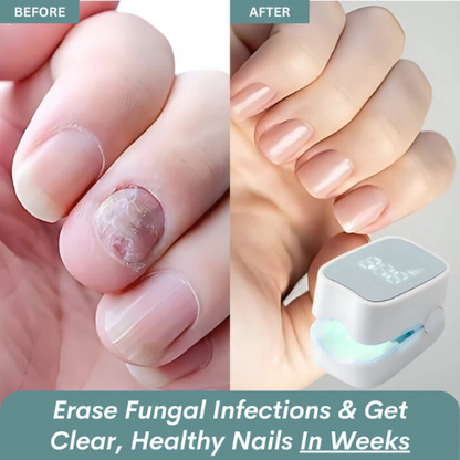 Buyera™ - Nail Fungus Laser Device