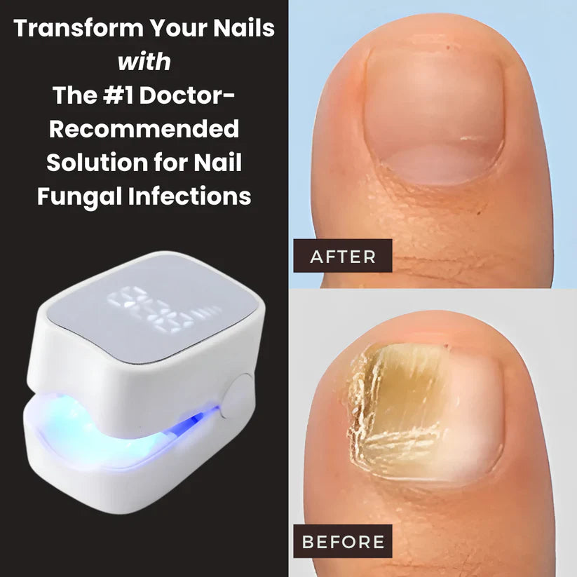 Buyera™ - Nail Fungus Laser Device