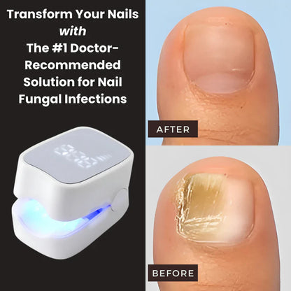 Buyera™ - Nail Fungus Laser Device